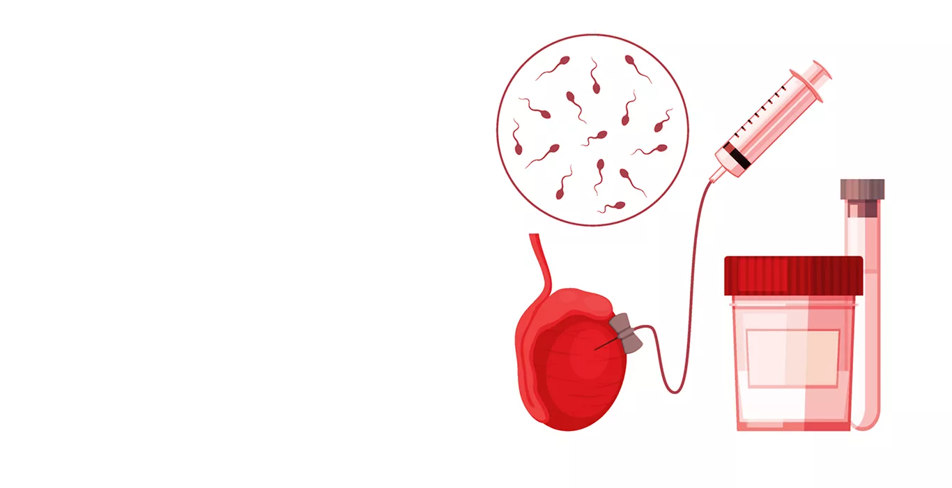 sperm-dna-fragmentation-test-procedure-step-by-step-indira-ivf
